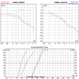 audiométrie tonale